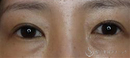 症例写真 術後 二重全切開後修正