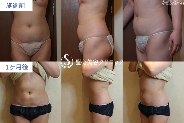 症例写真 術前術後比較 ベイザーリポ2.2脂肪吸引 腹部