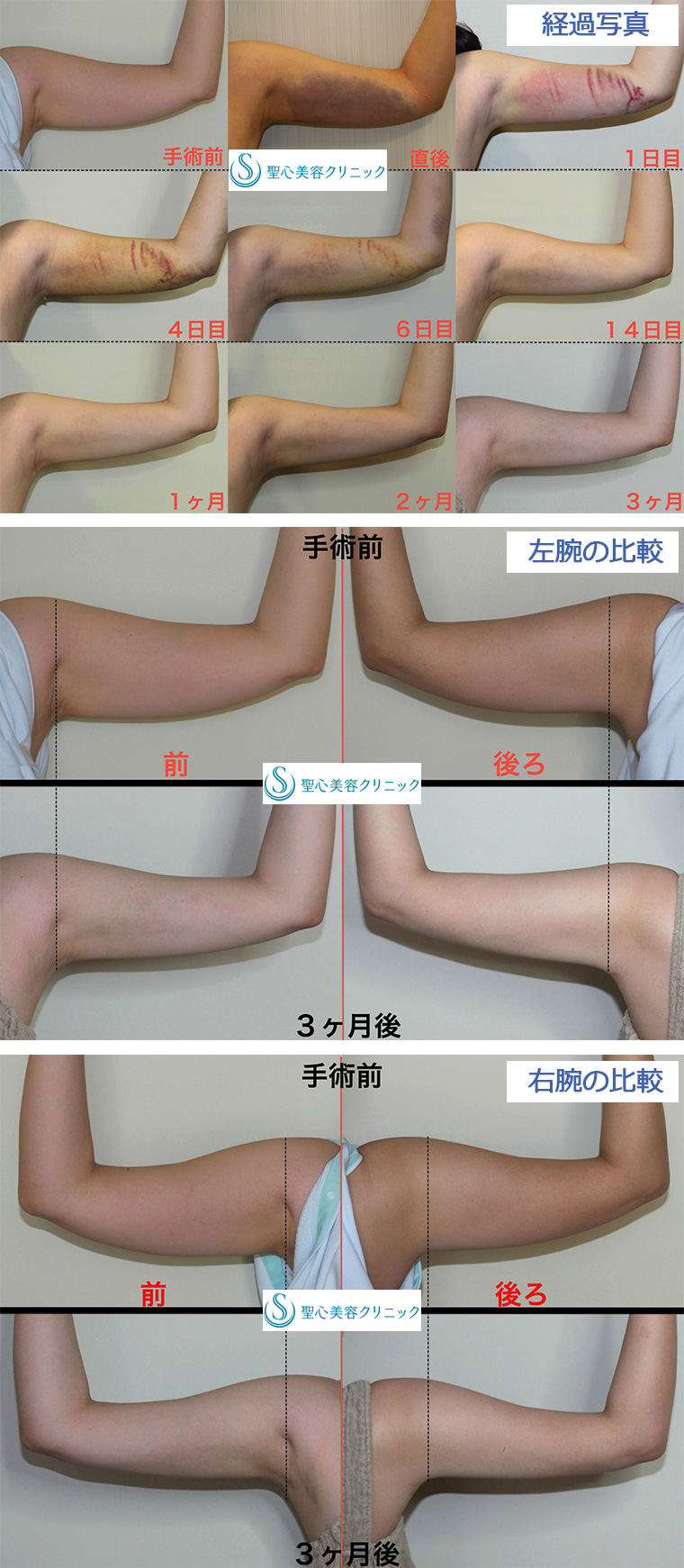症例写真 術前術後比較 ベイザーリポ2.2脂肪吸引 二の腕