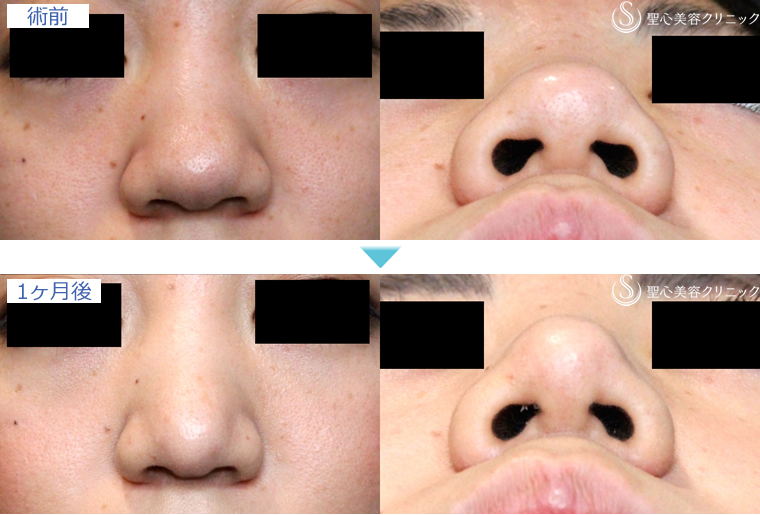 症例写真 術前後比較 鼻の整形