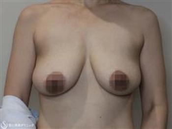症例写真 術前 乳房吊り上げ術