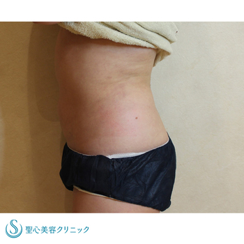 症例写真 術後 ベイザーリポ2.2脂肪吸引 腹部
