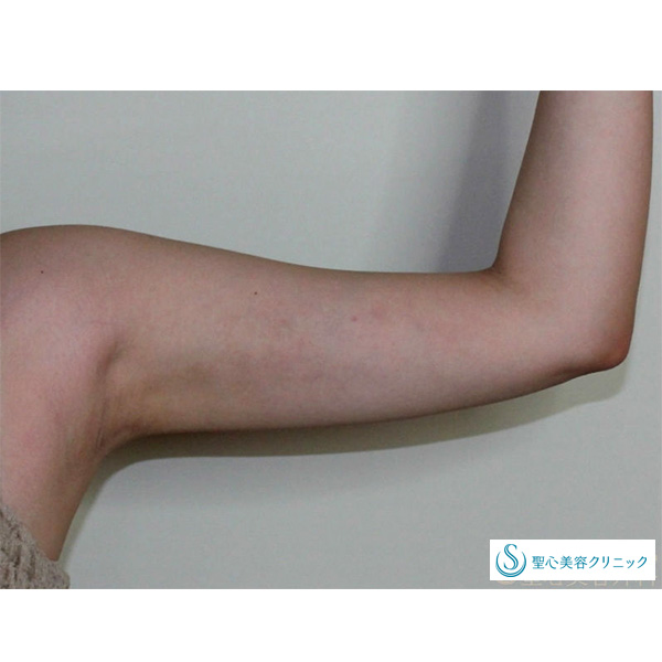 症例写真 術後 ベイザーリポ2.2脂肪吸引 二の腕