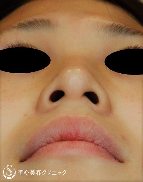 症例写真 術前 プロテーゼ＋鼻尖縮小＋鼻尖形成（耳介軟骨移植）