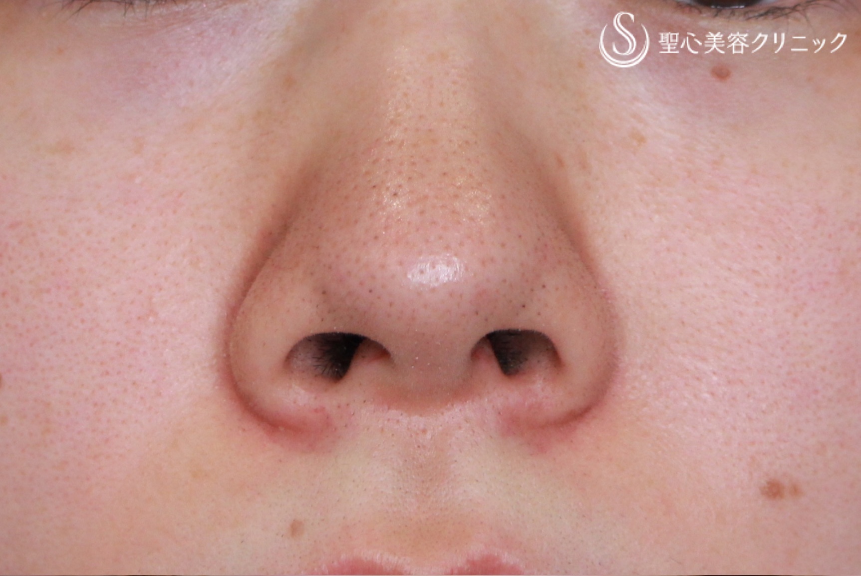 鼻の整形 わし鼻 の症例写真 聖心美容クリニック大宮院