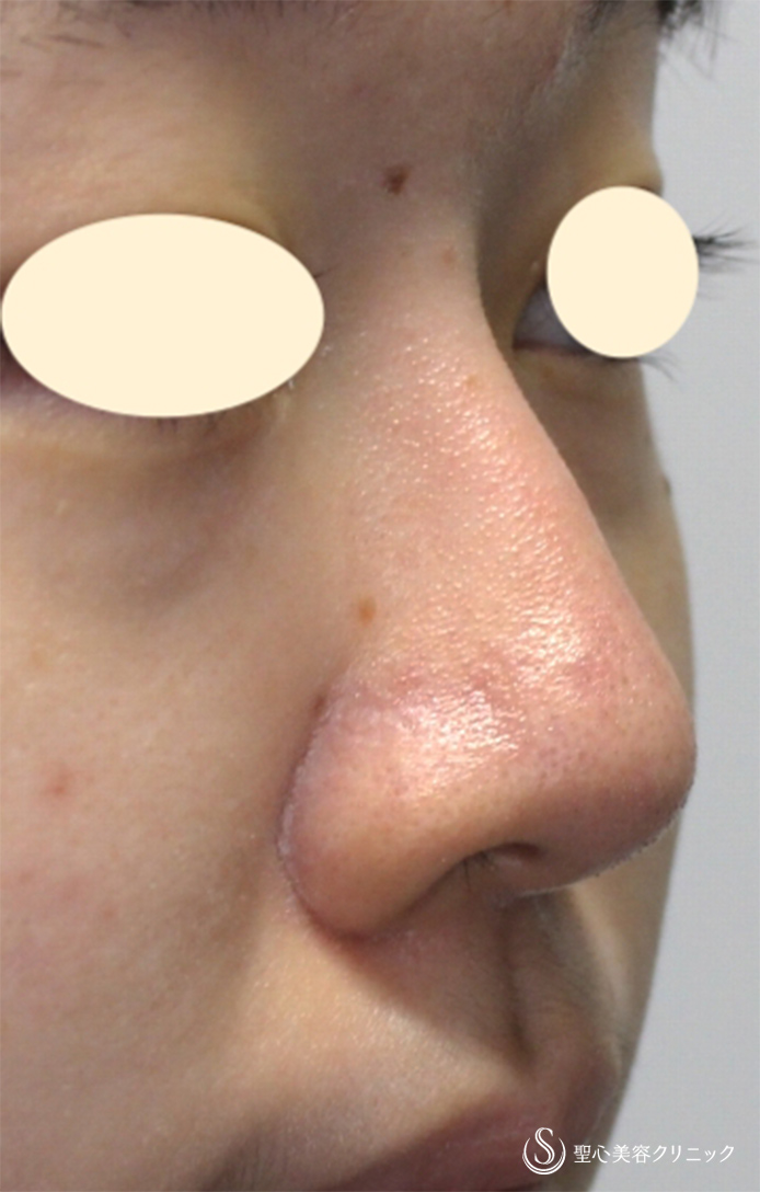 鼻の整形 鼻の穴 の症例写真 聖心美容クリニック大宮院