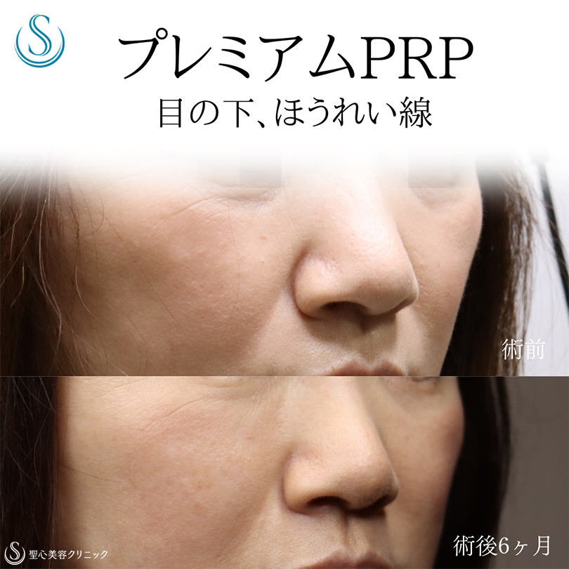 プレミアムPRP皮膚再生療法_After