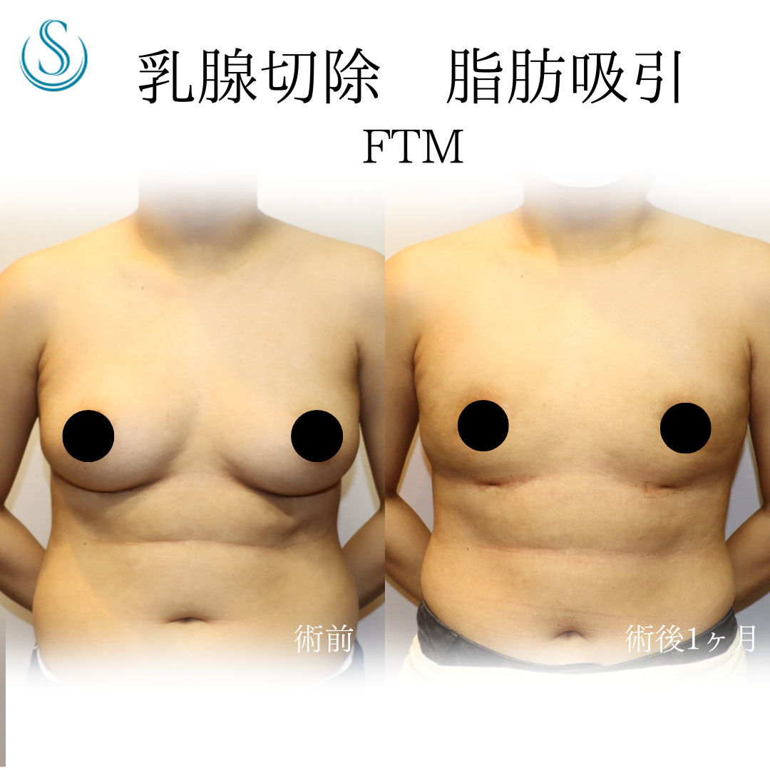 乳房切除（性同一性障害：FTM）_After