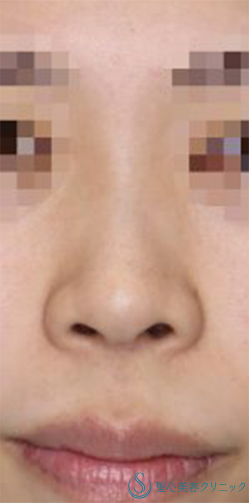 鼻尖縮小+鼻尖形成（耳介軟骨移植）+G-Mesh（Gメッシュ）+鼻尖形成（ストラット法）_Before