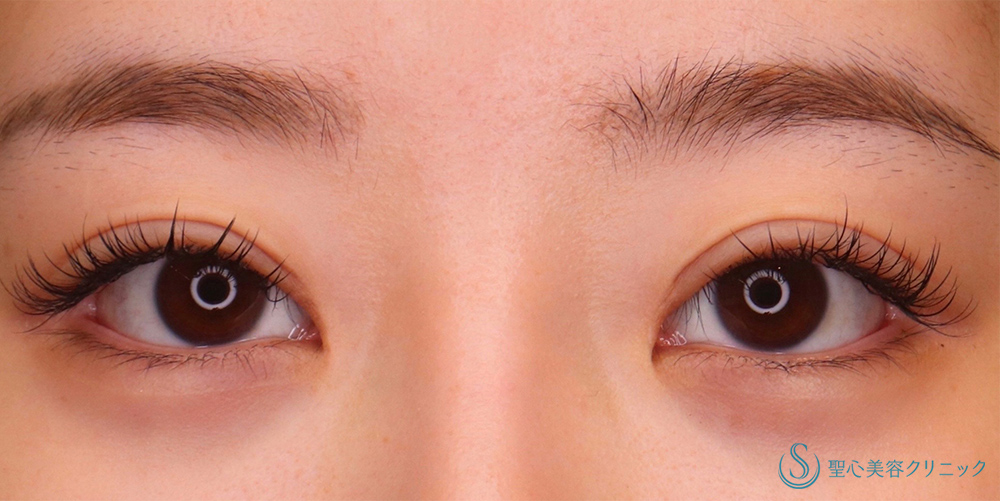 目頭切開/目上切開_After