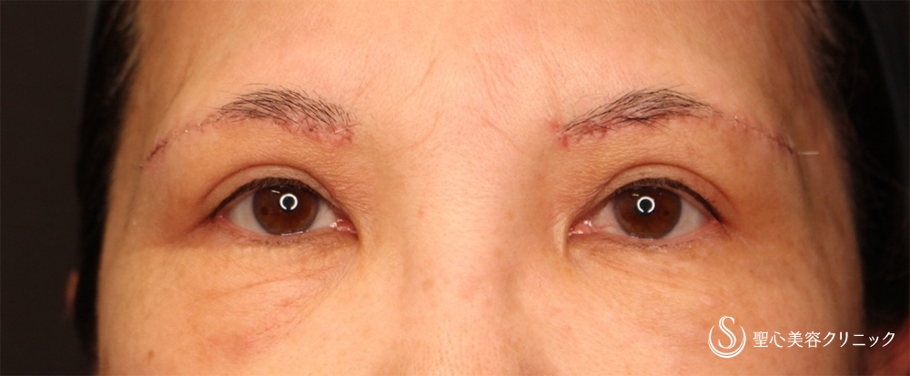 眉下切開法（眉下リフト）_After