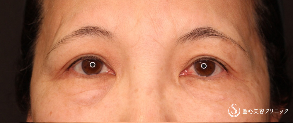眉下切開法（眉下リフト）_Before