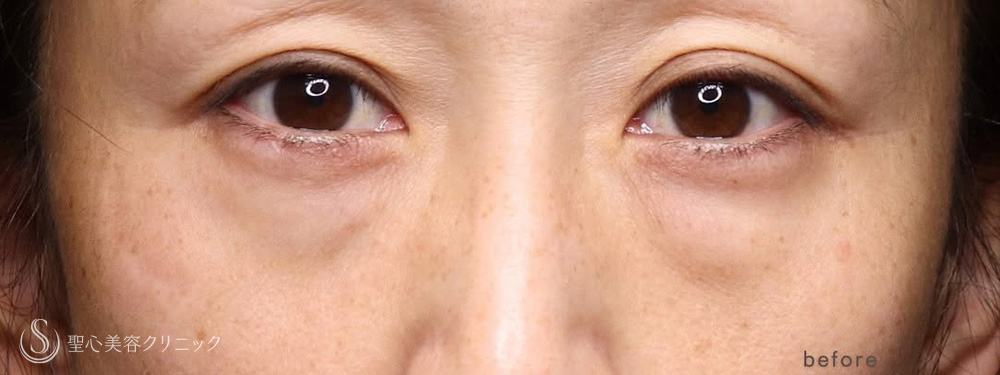 下眼瞼切開術/下眼瞼除皺術/ハムラ法_Before