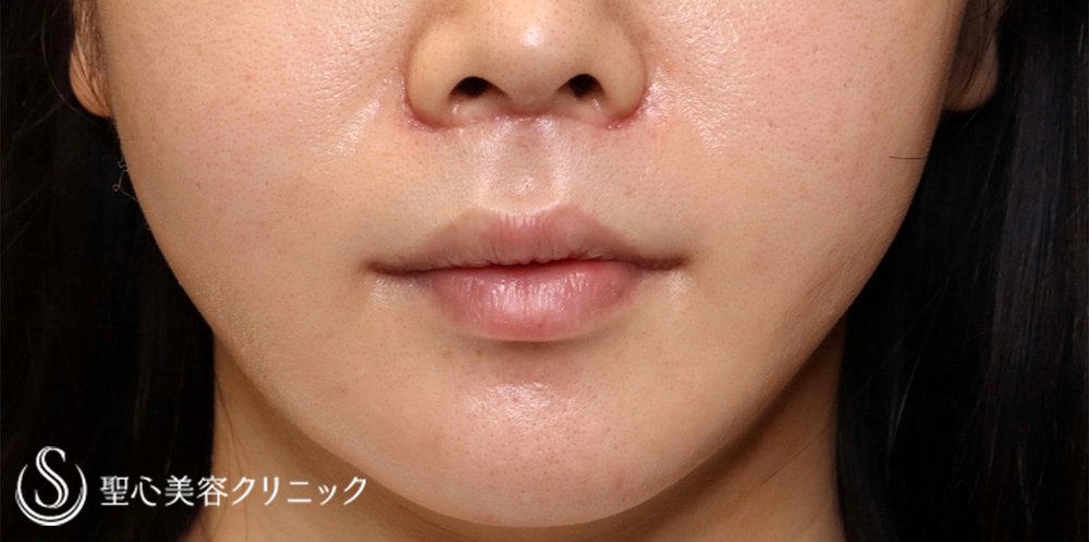 鼻下短縮術（リップリフト/人中短縮）＋スマイルリップ_After