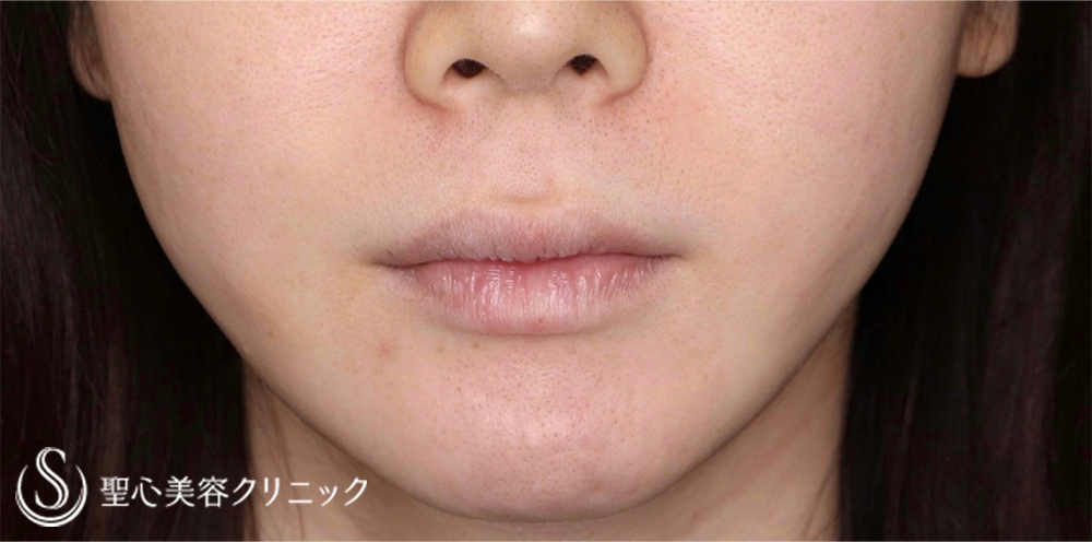 鼻下短縮術（リップリフト/人中短縮）＋スマイルリップ_Before