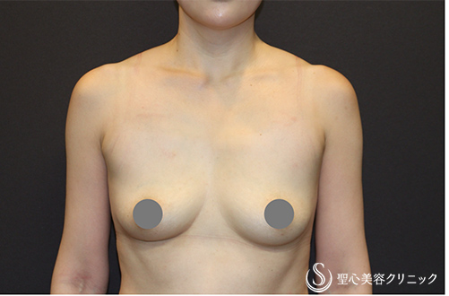 バッグプロテーゼ挿入法_Before