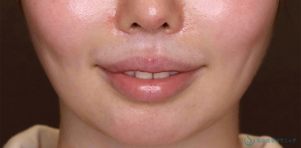 鼻下短縮術（リップリフト/人中短縮）_After