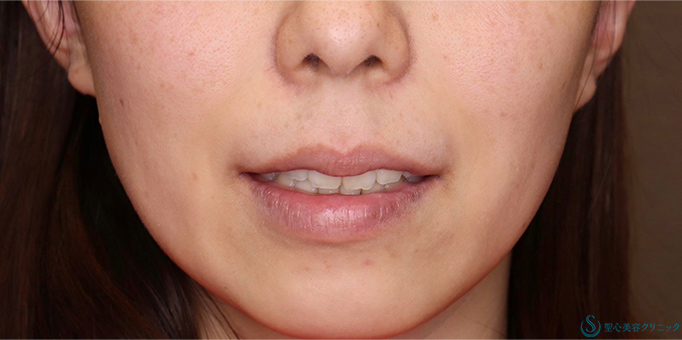 鼻下短縮術（リップリフト/人中短縮）_Before