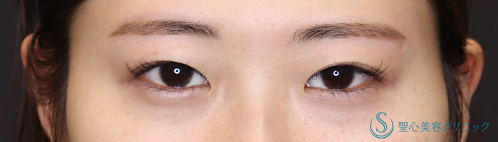 目上切開_Before