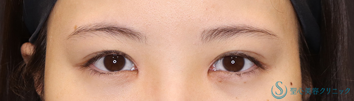 目頭切開/目上切開_After