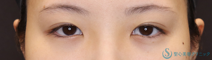 目頭切開/目上切開_Before