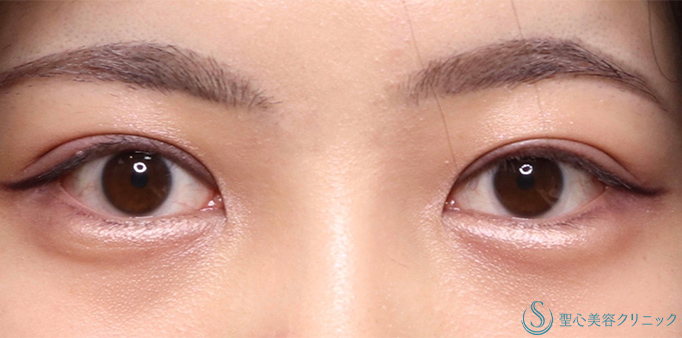 二重術（切開法）部分切開/全切開_After