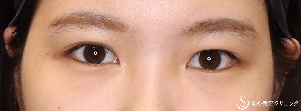 二重術（埋没法）：マイクロメソッド+α_After