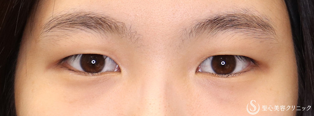 二重術（埋没法）：マイクロメソッド+α_Before