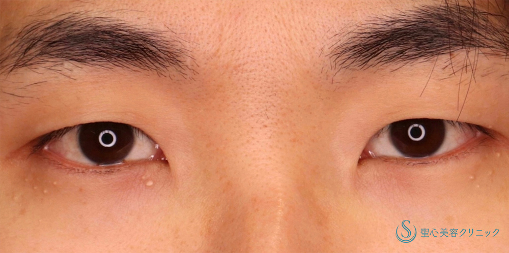 眉下切開法（眉下リフト）＋ 二重術（埋没法）：マイクロメソッド+α_Before