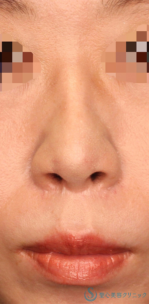 鼻孔縁下降術_After