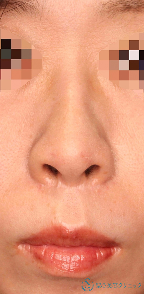 鼻孔縁下降術_Before
