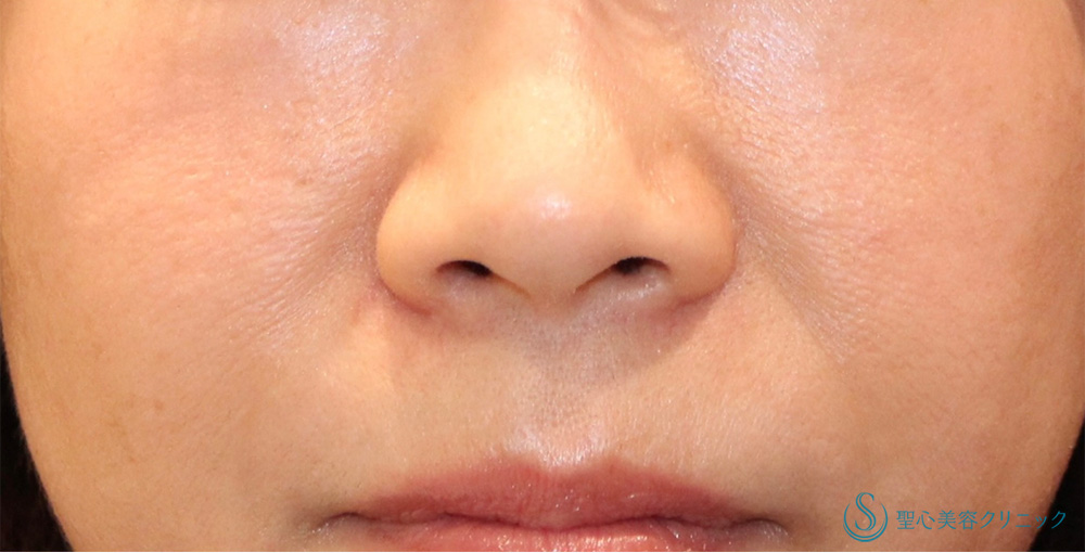 小鼻縮小_Before