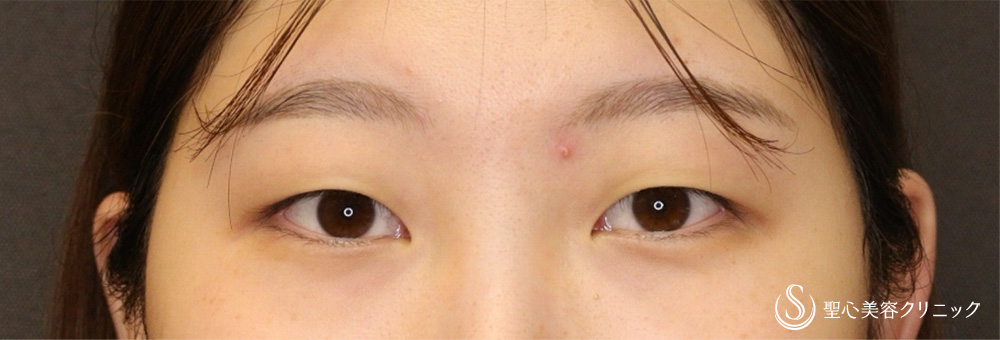 二重術（埋没法）：マイクロメソッド+α_Before