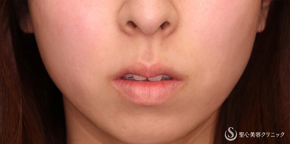 鼻下短縮術（リップリフト/人中短縮）_Before