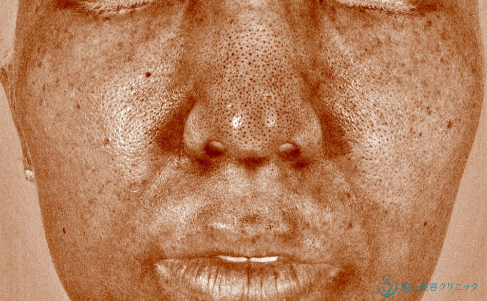 ピコレーザー_After