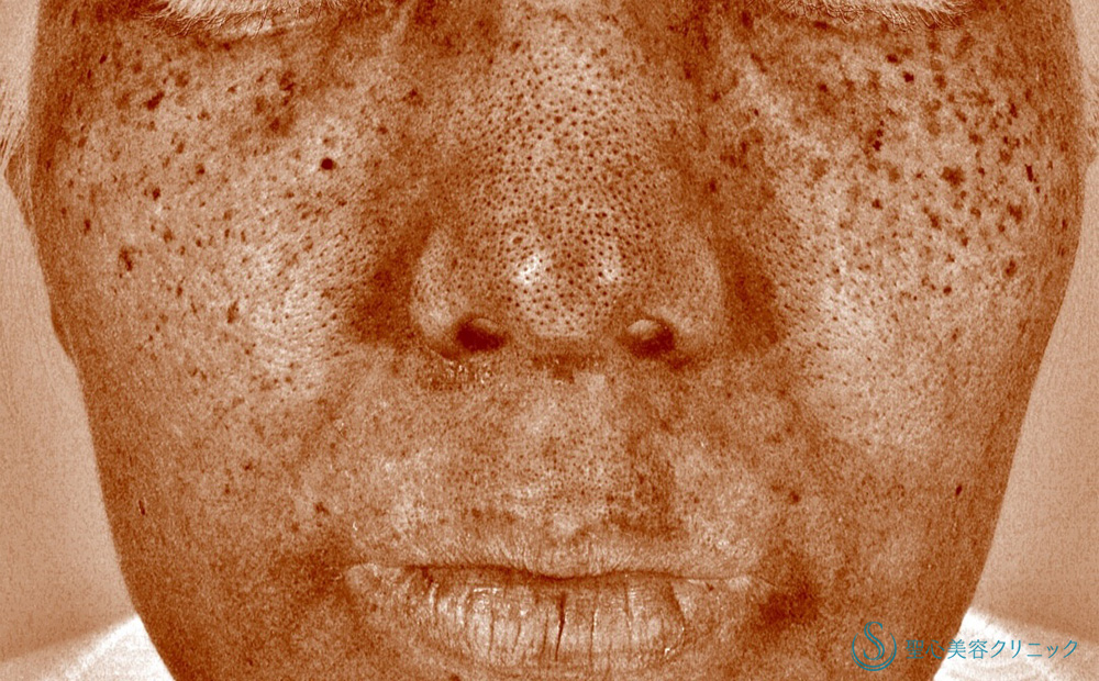 ピコレーザー_Before