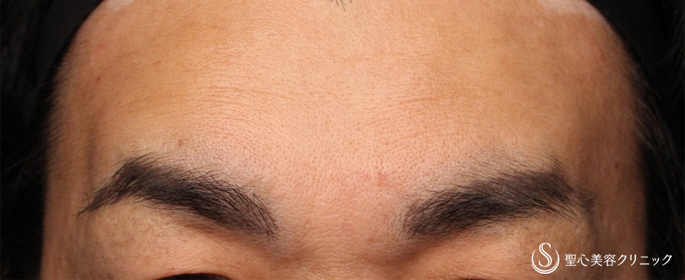 プレミアムPRP皮膚再生療法_After