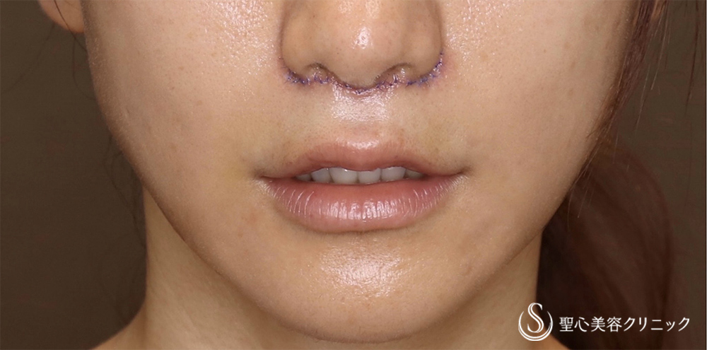 鼻下短縮術（リップリフト/人中短縮）_After