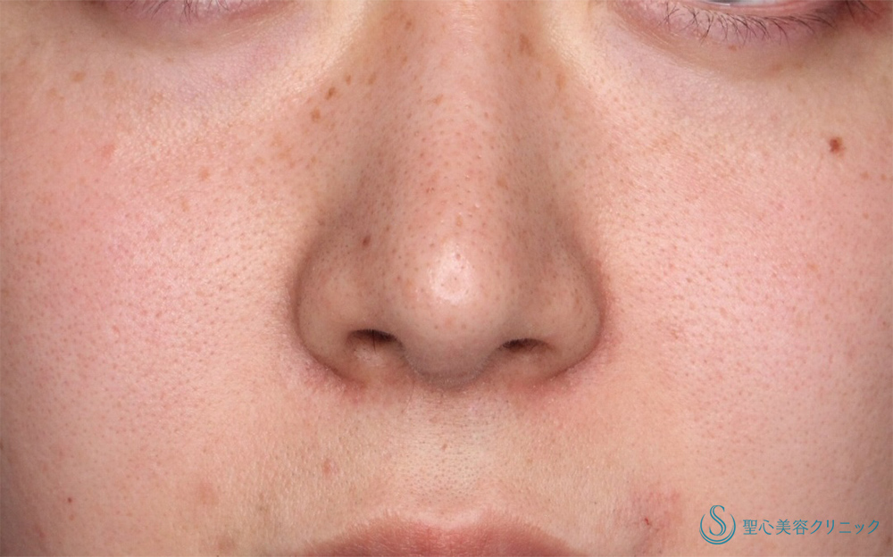 鼻孔縁下降術_After