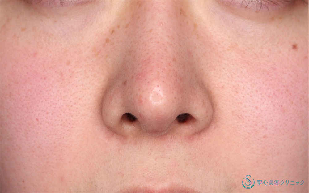 鼻孔縁下降術_Before