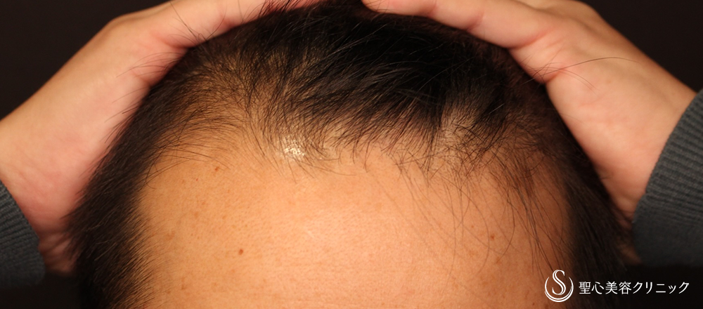 EXOHAIR EVs（エクソヘア イーヴィーズ）_After