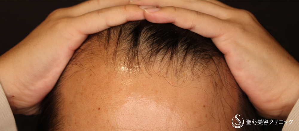 EXOHAIR EVs（エクソヘア イーヴィーズ）_Before