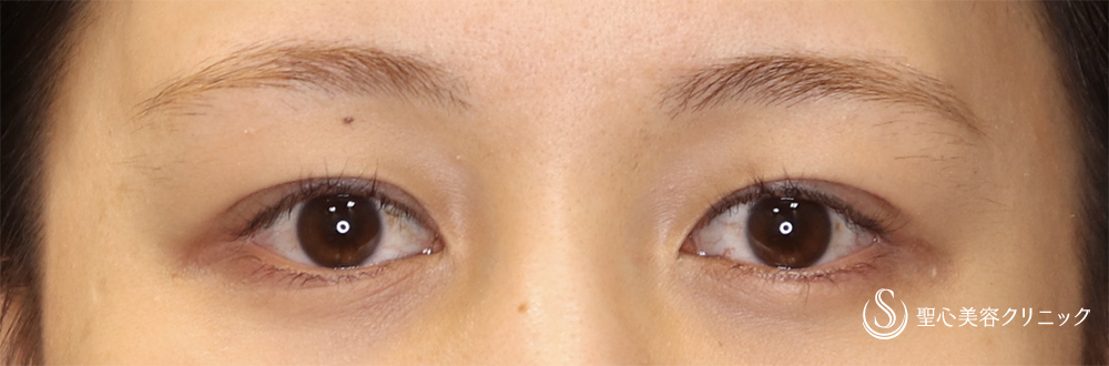 二重術（埋没法）：マイクロメソッド+α_After