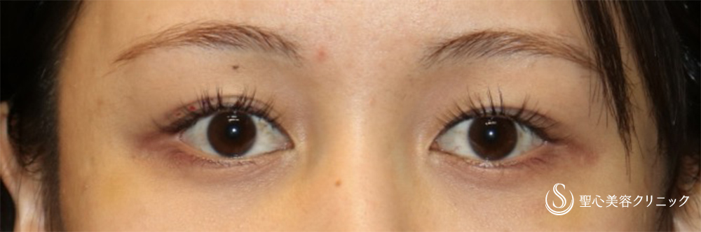 二重術（埋没法）：マイクロメソッド+α_Before