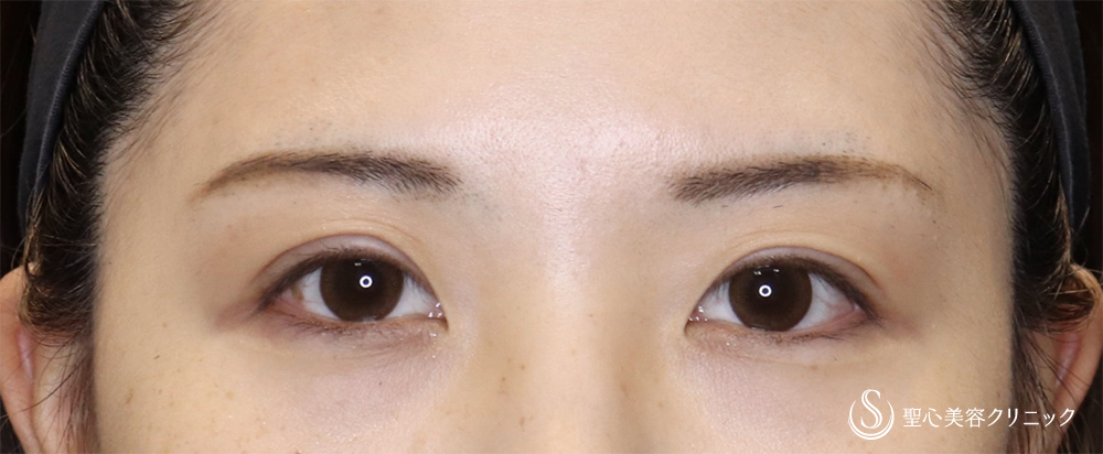 二重術（切開法）部分切開/全切開_After