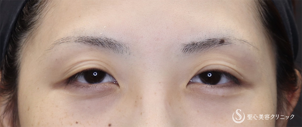 二重術（切開法）部分切開/全切開_Before