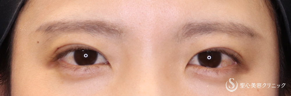 二重術（埋没法）：マイクロメソッド+α_After