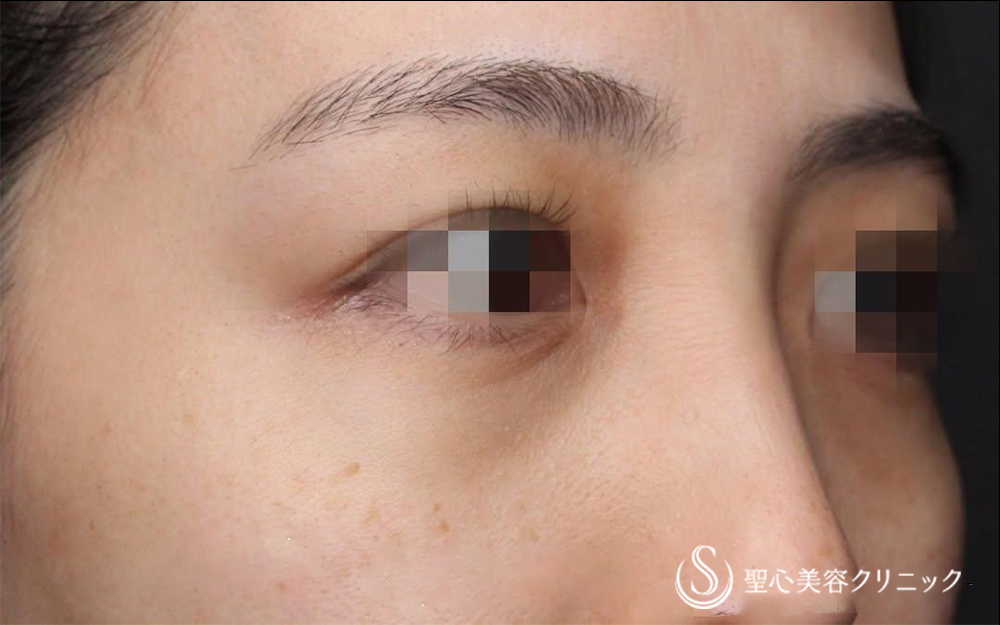 目の下の脂肪取り（経結膜下脱脂法）_After