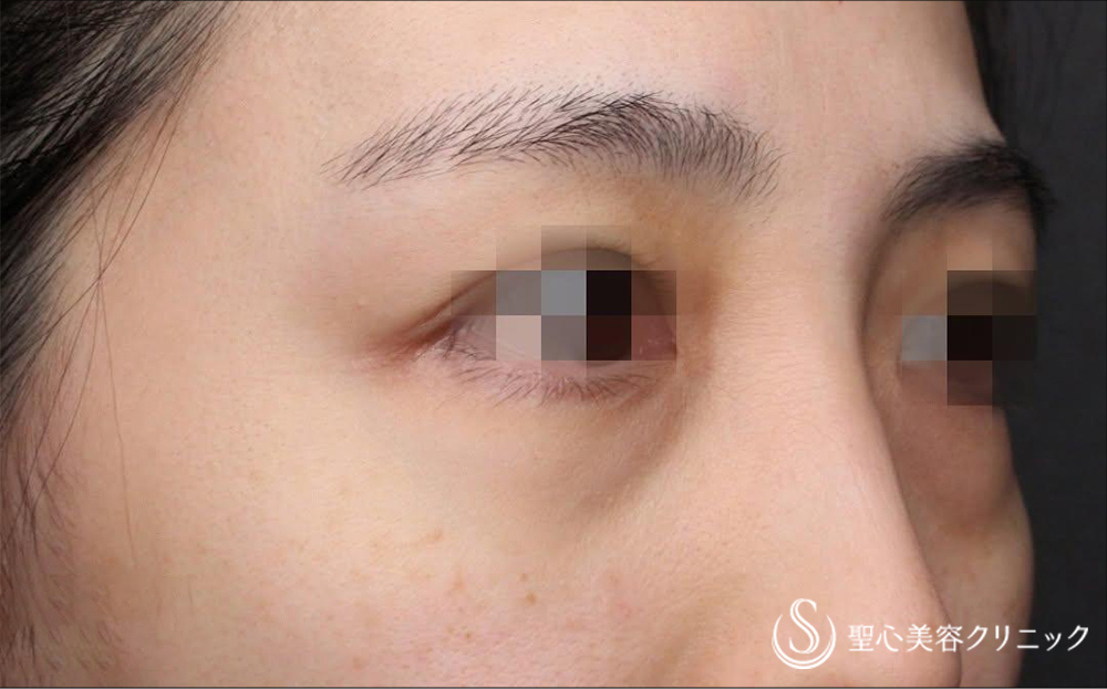 目の下の脂肪取り（経結膜下脱脂法）_Before