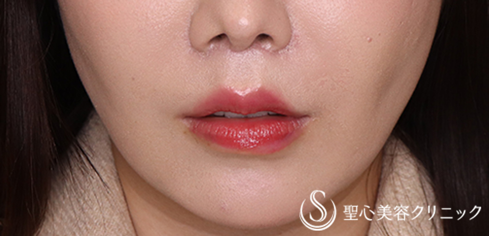 鼻下短縮術（リップリフト/人中短縮）_After